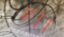 “死亡buff”叠满！饭后一包烟，10年心梗2次