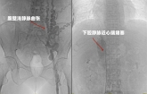 温江大姐双腿变黑，擦伤多月无法愈合，竟是这怪病找上了她