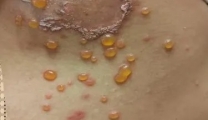腋下生神秘水疱，老年人小心被TA盯上