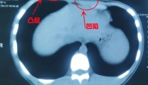 温江13岁孩子“鸡胸”合并“漏斗胸”，医生表示：不要错过最佳治疗时机
