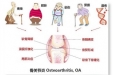 健康科普 | 骨关节炎来袭，从病因到治疗，告别误区全攻略