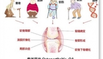 健康科普 | 骨关节炎来袭，从病因到治疗，告别误区全攻略