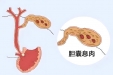 胆囊息肉：别怕，来揭开它的神秘面纱！