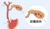 胆囊息肉：别怕，来揭开它的神秘面纱！