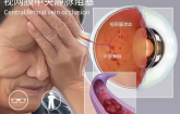 晨练时眼前突然模糊，六旬大叔差点失明！这个“眼部堵车”的毛病太凶险