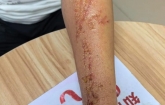 这虫是“飞行硫酸”！有人随手一拍，手臂直接“腐蚀”，很多人已中招