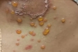 腋下生神秘水疱，老年人小心被TA盯上